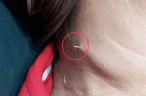 [매일경제] 잘못 삼킨 생선가시 의사도 못 찾았는데…목 뚫고 튀어나왔다