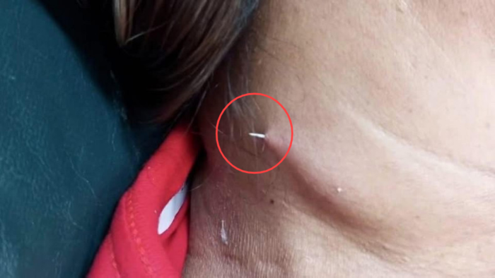 [매일경제] 잘못 삼킨 생선가시 의사도 못 찾았는데…목 뚫고 튀어나왔다