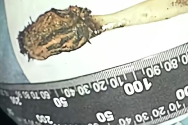 [매일경제] 뱃속 이상해서 병원 갔는데…장에서 발견된 17cm 길이의 물체 ‘충격’