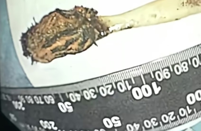 [매일경제] 뱃속 이상해서 병원 갔는데…장에서 발견된 17cm 길이의 물체 ‘충격’