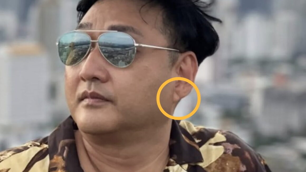 [뉴스] 심정지 김수용, 귓볼에서 발견된 선명한 프랭크 징후