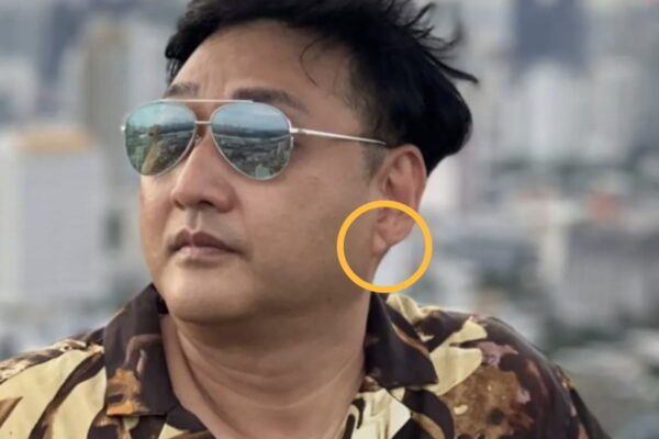 [뉴스] 심정지 김수용, 귓볼에서 발견된 선명한 프랭크 징후