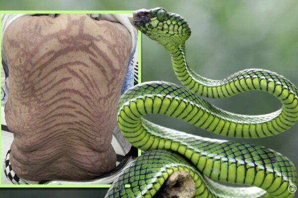 [뉴스] 거울보다 충격, 온몸에 끔찍한 ‘뱀 무늬’…‘만병통치’에 속아 2천만원 쓴 중국女