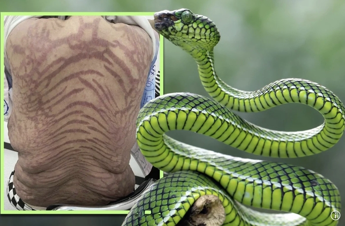 [뉴스] 거울보다 충격, 온몸에 끔찍한 ‘뱀 무늬’…‘만병통치’에 속아 2천만원 쓴 중국女