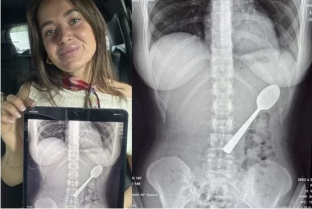 [뉴스] 반려견에 놀라 17cm 숟가락 삼킨 벨기에 여성…엑스레이 사진 보니 ‘아찔’