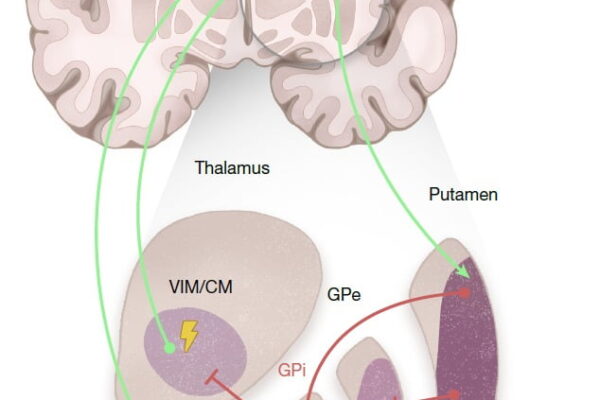 [뉴스] 파킨슨병 치료 효과 2.5배 높일 방법 찾았다…관련 시장도 주목